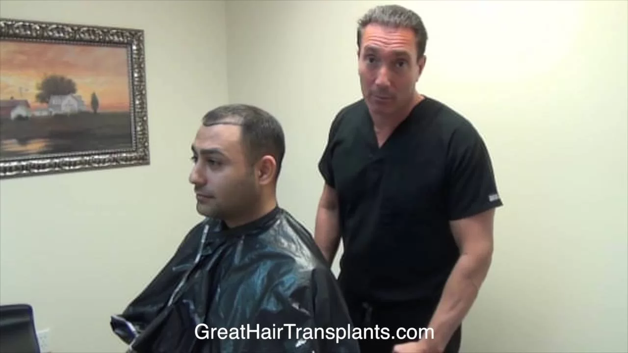Dr. Bolton Patient Amir MaxHarvest &trade; Hair Transplant Plus 

