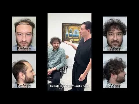 Dr. Bret Bolton Patient Mark MaxHarvest Hair Transplant Procedure