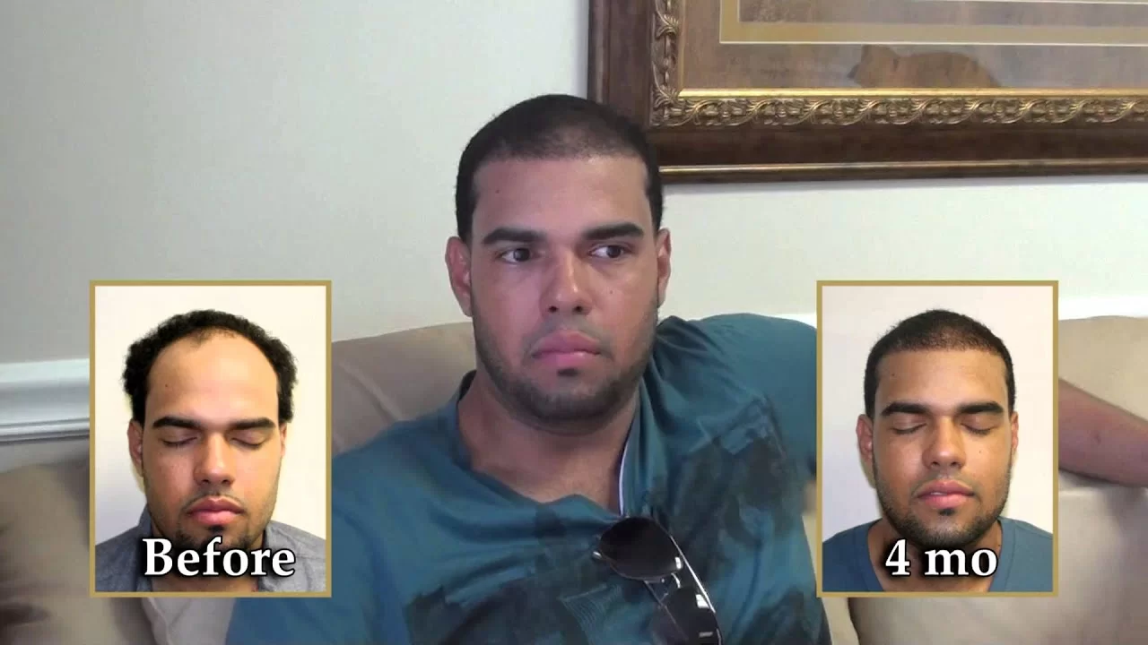 Dr. Brett Bolton Young Male Gets his Youthful Hairline Back in Only 4 months