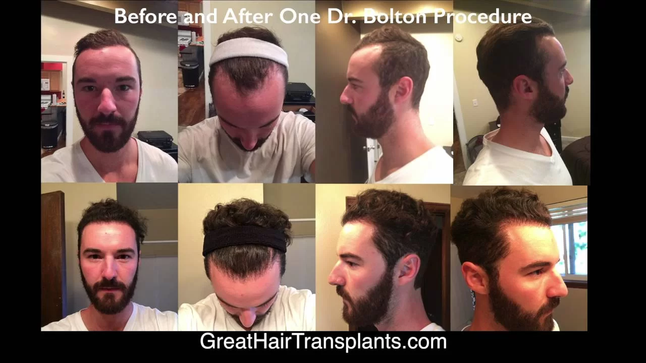 
Dr. Brett Bolton FUE / Robotic Correction Patient Casey Short Testimonial
