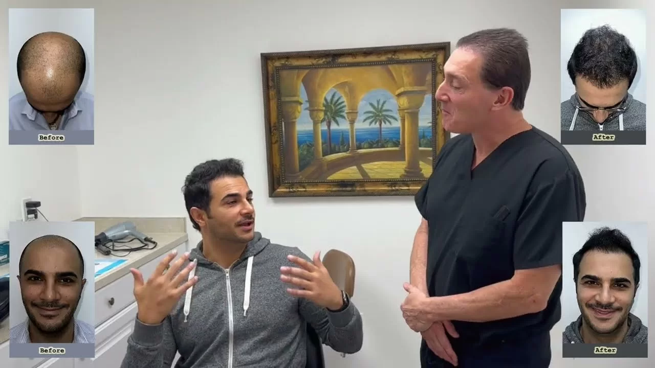 Dr. Brett Bolton performed another excellent Maxharvest Plus Hair Transplant for his patient Igor