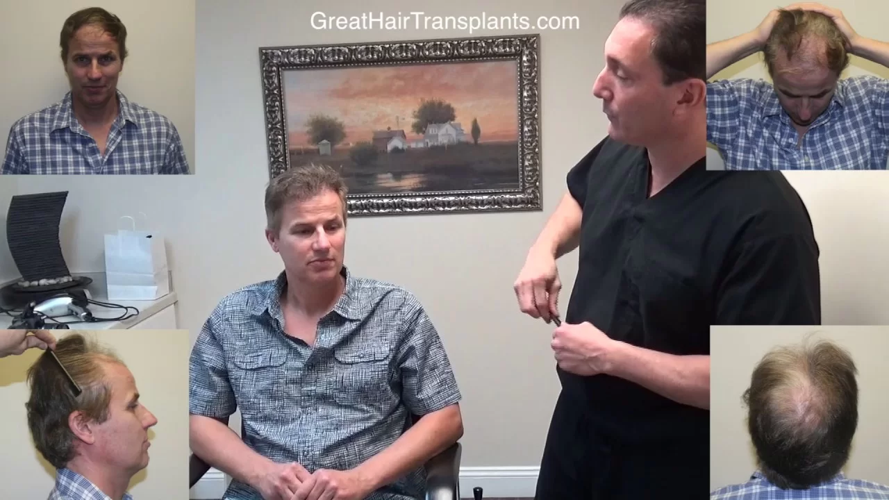

Dr. Brett Bolton Hair Transplant Patient James from Alaska
