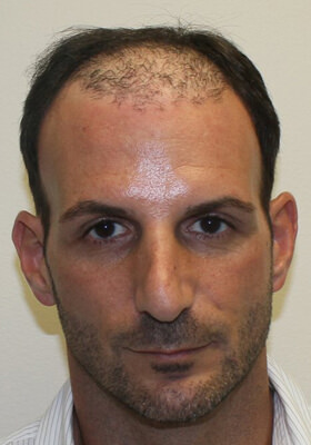 Nick Alberto Front Before