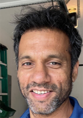 Srini One Year Hair Transplant Result