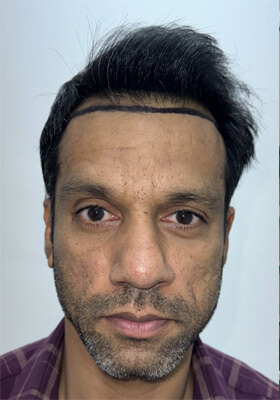Srini Before Hair Transplant