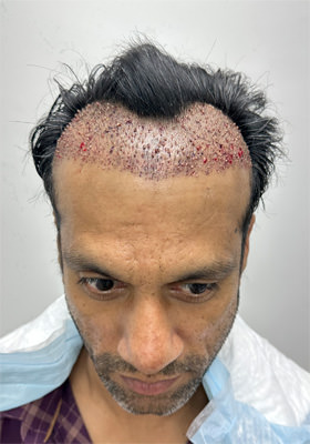 Srini Immediately After Hair Transplant