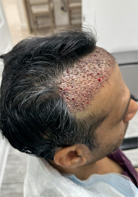Srini Right Side Immediately After Hair Transplant