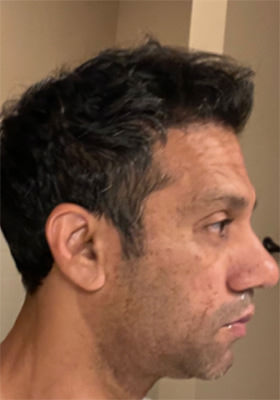 Srini Right Side One Year After Hair Transplant