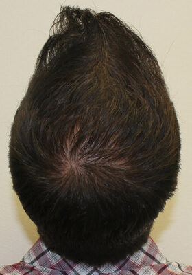 Ryan Crown Procedure 2