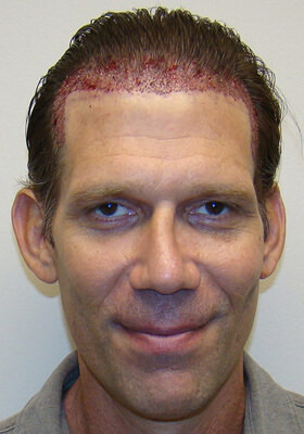 Front New Grafts