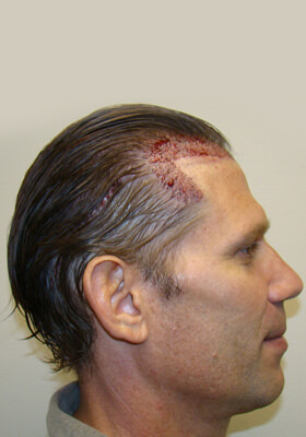 Right New Grafts