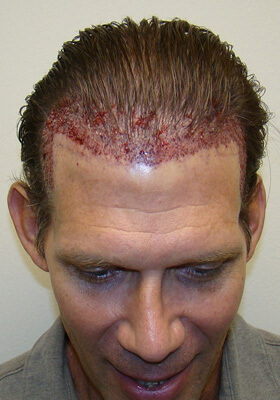 Tilt New Grafts