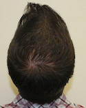 Ryan Crown View After Second Procedure