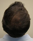 Ryan Crown View After First Surgery