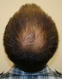 Ryan Crown View Before
