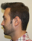 Ryan Left View After Second Procedure