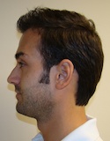 Ryan Left View After First Surgery