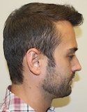 Ryan Right View After Second Procedure