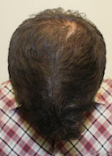 Ryan Tilt View After Second Procedure