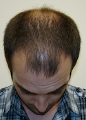 Ryan Tilt View Before