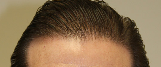 Final Hair Growth