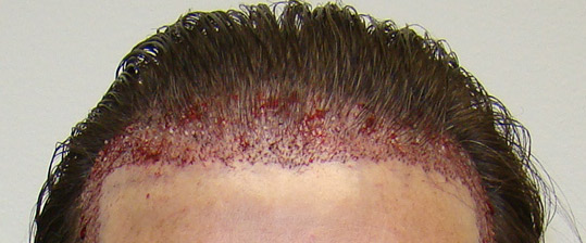 Immediately After Surgery