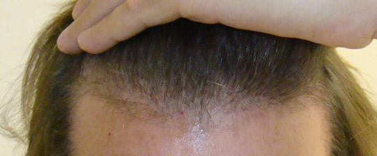 Early Hair Growth