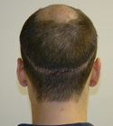 Ryan Hair Transplant Donor Area 9 Days