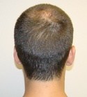 Ryan Hair Transplant Donor Area 3 Months