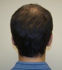 Ryan Hair Transplant Donor Area 6 Months