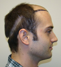 Ryan Hair Transplant Donor Area Shaved