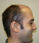 Ryan Hair Transplant Donor Area Immediately After Procedure