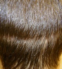 Ryan Hair Transplant Donor Area 4 Days