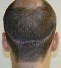 Ryan Hair Transplant Donor Area 6 Days