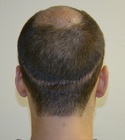 Ryan Hair Transplant Donor Area 7 Days