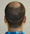 Ryan Hair Transplant Donor Area 8 Days
