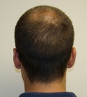 Ryan Hair Transplant Donor Area 12 Days