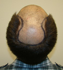 Ryan Hair Transplant Crown View Target Area