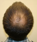 Ryan Hair Transplant Crown View Before