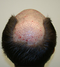 Ryan Hair Transplant Crown View Immediately After