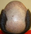 Ryan Hair Transplant Crown View 4 Days