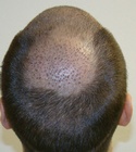 Ryan Hair Transplant Crown View 6 Days