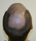 Ryan Hair Transplant Crown View 7 Days