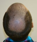 Ryan Hair Transplant Crown View 8 Days