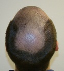 Ryan Hair Transplant Crown View 9 Days