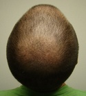 Ryan Hair Transplant Crown View 12 Days