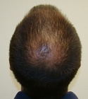 Ryan Hair Transplant Crown View 3 Months