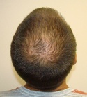 Ryan Hair Transplant Crown View 5 Months