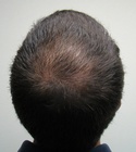 Ryan Hair Transplant Crown View 6 Months