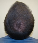 Ryan Hair Transplant Crown View 7 Months